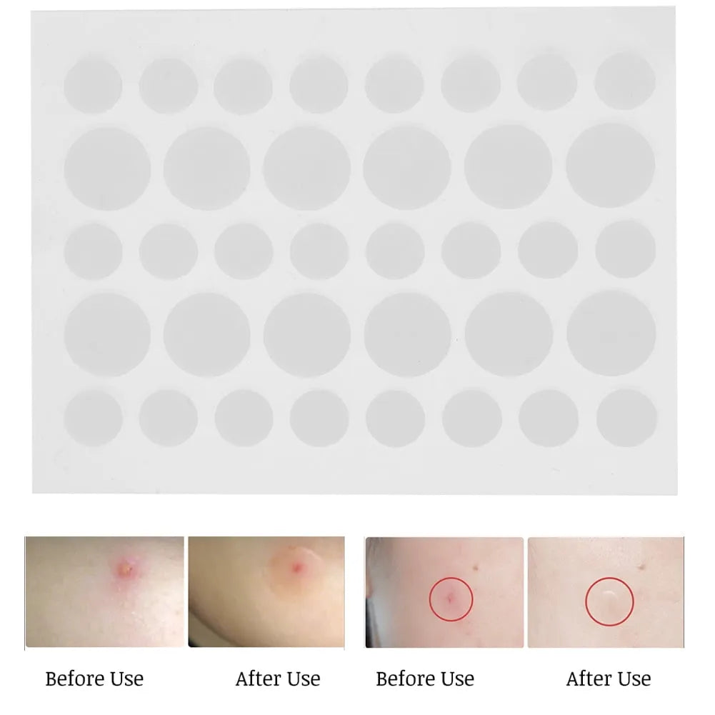 24 Parches Para Eliminar El Acné